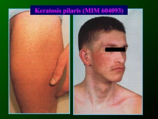 Keratosis pilaris (MIM 604093)
 
