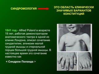 СИНДРОМОЛОГИЯ
ЭТО ОБЛАСТЬ КЛИНИЧЕСКИ
ЗНАЧИМЫХ ВАРИАНТОВ
КОНСТИТУЦИЙ
1841 год - Alfred Poland в возрасте
19 лет, работая демонстратором
анатомического театра в одной из
клиник Лондона, описал сочетание
синдактилии, агенезии малой
грудной мышцы и стернальной
порции большой грудной мышцы. В
настоящее время это сочетание
известно как
< Синдром Поланда >
 