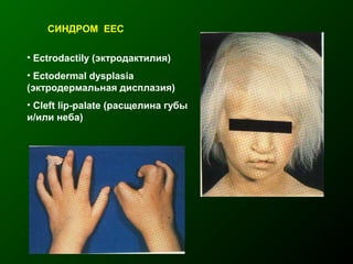 СИНДРОМ EEC
• Ectrodactily (эктродактилия)
• Ectodermal dysplasia
(эктродермальная дисплазия)
• Cleft lip-palate (расщелина губы
и/или неба)
 
