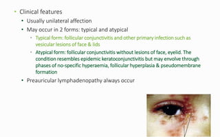 • Clinical features
• Usually unilateral affection
• May occur in 2 forms: typical and atypical
• Typical form: follicular conjunctivitis and other primary infection such as
vesicular lesions of face & lids
• Atypical form: follicular conjunctivitis without lesions of face, eyelid. The
condition resembles epidemic keratoconjunctivitis but may envolve through
phases of no-specific hyperaemia, follicular hyperplasia & pseudomembrane
formation
• Preauricular lymphadenopathy always occur
 