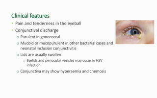 Clinical features
• Pain and tenderness in the eyeball
• Conjunctival discharge
o Purulent in gonococcal
o Mucoid or mucopurulent in other bacterial cases and
neonatal inclusion conjunctivitis
o Lids are usually swollen
o Eyelids and periocular vesicles may occur in HSV
infection
o Conjunctiva may show hyperaemia and chemosis
 