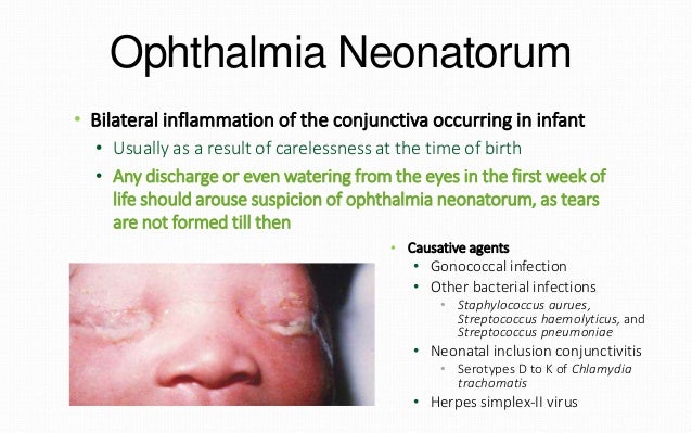 viral conjuctivitis