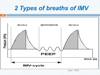 2 Types of breaths of IMV
June 1, 2016
38
 