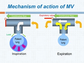 Mechanism of action of MV
Patient
lung
Expiration
Patient
lung
Inspiration
Expiratory valve
Leak
Continuous flowContinuous flow
spontaneous
 