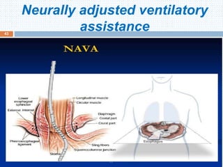 Neurally adjusted ventilatory
assistance
June 1, 2016
43
 