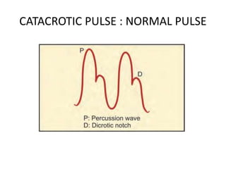 CATACROTIC PULSE : NORMAL PULSE
 