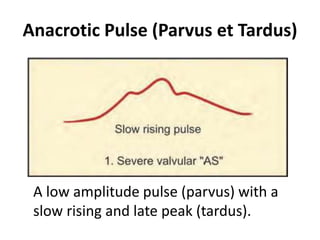 Anacrotic Pulse (Parvus et Tardus)
A low amplitude pulse (parvus) with a
slow rising and late peak (tardus).
 