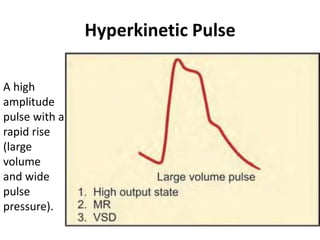 Hyperkinetic Pulse
A high
amplitude
pulse with a
rapid rise
(large
volume
and wide
pulse
pressure).
 