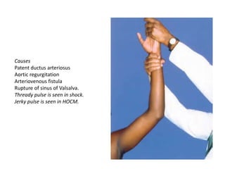 Causes
Patent ductus arteriosus
Aortic regurgitation
Arteriovenous fistula
Rupture of sinus of Valsalva.
Thready pulse is seen in shock.
Jerky pulse is seen in HOCM.
 