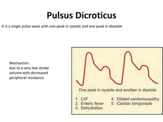 Pulsus Dicroticus
Mechanism :
due to a very low stroke
volume with decreased
peripheral resistance
It is a single pulse wave with one peak in systole and one peak in diastole
 