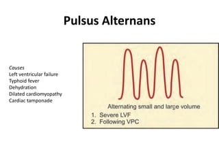 Pulsus Alternans
Causes
Left ventricular failure
Typhoid fever
Dehydration
Dilated cardiomyopathy
Cardiac tamponade
 