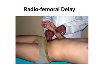 Radio-femoral Delay
 