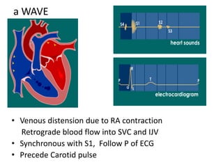 • Venous distension due to RA contraction
Retrograde blood flow into SVC and IJV
• Synchronous with S1, Follow P of ECG
• Precede Carotid pulse
a WAVE
 