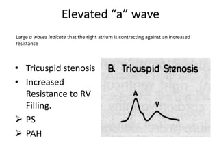 Elevated “a” wave
• Tricuspid stenosis
• Increased
Resistance to RV
Filling.
 PS
 PAH
Large a waves indicate that the right atrium is contracting against an increased
resistance
 
