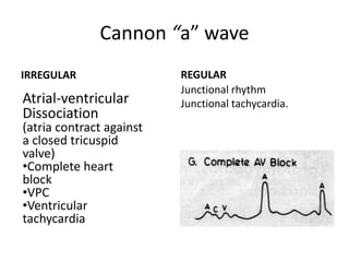 Cannon “a” wave
IRREGULAR REGULAR
Junctional rhythm
Junctional tachycardia.Atrial-ventricular
Dissociation
(atria contract against
a closed tricuspid
valve)
•Complete heart
block
•VPC
•Ventricular
tachycardia
 