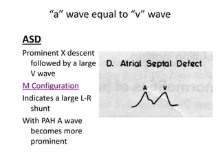 “a” wave equal to “v” wave
ASD
Prominent X descent
followed by a large
V wave
M Configuration
Indicates a large L-R
shunt
With PAH A wave
becomes more
prominent
 
