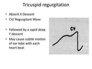 Tricuspid regurgitation
• Absent X Descent
• CV/ Regurgitant Wave
• Followed by a rapid deep
Y descent
• May cause subtle motion
of ear lobe with each
heart beat
 