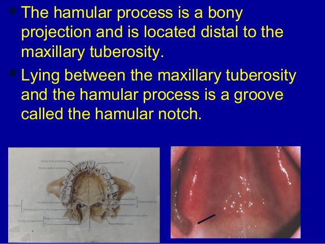 2 hand out hamular notch