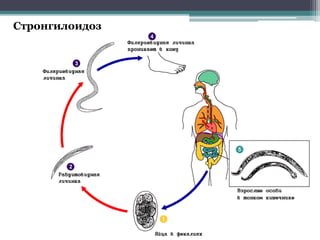 Стронгилоидоз
 