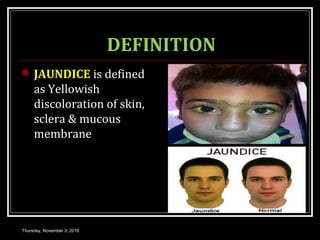 DEFINITION
 JAUNDICE is defined
as Yellowish
discoloration of skin,
sclera & mucous
membrane
Thursday, November 3, 2016
 