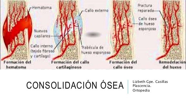 CONSOLIDACION OSEA DOWNLOAD CONSOLIDACION OSEA DOWNLOAD