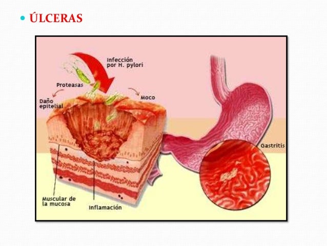 Sintomas de una inflamacion intestinal