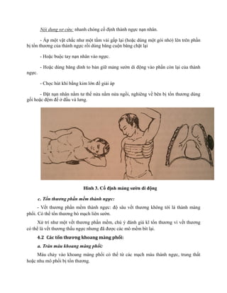 Nội dung sơ cứu: nhanh chóng cố định thành ngực nạn nhân.
- Áp một vật chắc như một tấm vải gấp lại (hoặc dùng một gói nhỏ) lên trên phần
bị tổn thương của thành ngực rồi dùng bǎng cuộn bǎng chặt lại
- Hoặc buộc tay nạn nhân vào ngực.
- Hoặc dùng bǎng dính to bản giữ mảng sườn di động vào phần còn lại của thành
ngực.
- Chọc hút khí bằng kim lớn để giải áp
- Đặt nạn nhân nằm tư thế nửa nằm nửa ngồi, nghiêng về bên bị tổn thương dùng
gối hoặc đệm để ở đầu và lưng.
Hình 3. Cố định mảng sƣờn di động
c. Tổn thương phần mềm thành ngực:
- Vết thương phần mềm thành ngực: độ sâu vết thương không tới lá thành màng
phổi. Có thể tổn thương bó mạch liên sườn.
Xử trí như một vết thương phần mềm, chú ý đánh giá kĩ tổn thương vì vết thương
có thể là vết thương thấu ngực nhưng đã được các mô mềm bít lại.
4.2 Các tổn thương khoang màng phổi:
a. Tràn máu khoang màng phổi:
Máu chảy vào khoang màng phổi có thể từ các mạch máu thành ngực, trung thất
hoặc nhu mô phổi bị tổn thương.
 