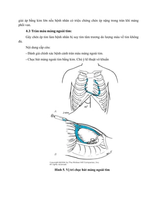 giải áp bằng kim lớn nếu bệnh nhân có triệu chứng chèn ép nặng trong tràn khí màng
phổi van.
4.3 Tràn máu màng ngoài tim:
Gây chèn ép tim làm bệnh nhân bị suy tim tâm trương do lượng máu về tim không
đủ.
Nội dung cấp cứu:
- Đánh giá chính xác bệnh cảnh tràn máu màng ngoài tim.
- Chọc hút màng ngoài tim bằng kim. Chú ý kĩ thuật vô khuẩn
Hình 5. Vị trí chọc hút màng ngoài tim
 