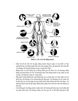 Hình 1. Các vị trí ấn động mạch
- Gấp chi tối đa: khi chi bị gấp, động mạch cũng bị gấp và các khối cơ bao
quanh đè ép vào động mạch làm cho máu ngừng chảy, áp dụng để cầm máu đối
với những vết thương không có gãy xương kèm theo.
- Băng chèn: là cách băng ép có dùng thêm gạc để chèn vào vết thương. Biện
pháp này thích hợp với các vết thương chảy máu động mạch ở sâu, giữa các kẽ
xương, vết thương vùng cổ, vùng chậu.
- Đặt garô là biện pháp cầm máu bằng dây cao su hoặc dây vải xoắn chặt vào chi
phía trên vết thương. Các trường hợp cần đặt garô: vết thương cụt chi, hoặc chi
bị đứt gần lìa; chi bị giập nát quá nhiều biết chắc không thể bảo tồn được, vết
thương mạch máu đã áp dụng những biện pháp cầm máu nói trên mà không có
kết quả.
- Cách đặt garô: ấn động mạch ở phía trên vết thương để cầm máu. Garô phải đặt
sát ngay phía trên vết thương, dùng vải hay gạc lót ở chỗ định đặt garô. Đặt
 