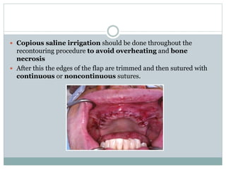  Copious saline irrigation should be done throughout the
recontouring procedure to avoid overheating and bone
necrosis
 After this the edges of the flap are trimmed and then sutured with
continuous or noncontinuous sutures.
 