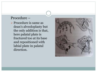 Procedure –
 Procedure is same as
dean’s alveoloplasty but
the only addition is that,
here palatal plate is
fractured too at its base
and repositioned with
labial plate in palatal
direction.
 