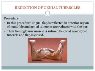 REDUCTION OF GENIAL TUBERCLES
Procedure:
 In this procedure lingual flap is reflected in anterior region
of mandible and genial tubercles are reduced with the bur.
 Then Genioglossus muscle is sutured below at geniohyoid
tubercle and flap is closed.
 