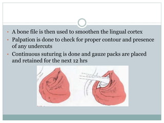 • A bone file is then used to smoothen the lingual cortex
• Palpation is done to check for proper contour and presence
of any undercuts
• Continuous suturing is done and gauze packs are placed
and retained for the next 12 hrs
 