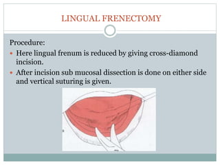 LINGUAL FRENECTOMY
Procedure:
 Here lingual frenum is reduced by giving cross-diamond
incision.
 After incision sub mucosal dissection is done on either side
and vertical suturing is given.
 