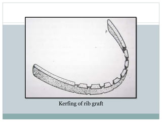 Kerfing of rib graft
 