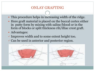 ONLAY GRAFTING
 This procedure helps in increasing width of the ridge.
 Here graft material is placed on the buccal cortex either
in putty form by mixing with saline/blood or in the
form of blocks or split thickness rib/illiac crest graft.
 Advantages:
 Improves width and to some extent height too.
 Can be used in anterior and posterior region.
 