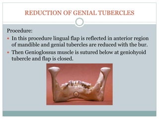 REDUCTION OF GENIAL TUBERCLES
Procedure:
 In this procedure lingual flap is reflected in anterior region
of mandible and ...