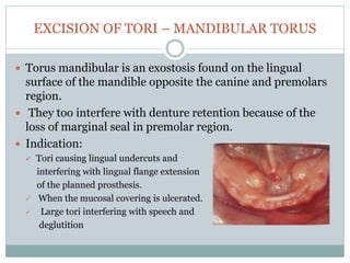 EXCISION OF TORI – MANDIBULAR TORUS
 Torus mandibular is an exostosis found on the lingual
surface of the mandible opposi...