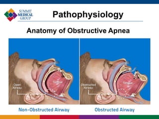 Pathophysiology
Anatomy of Obstructive Apnea
 