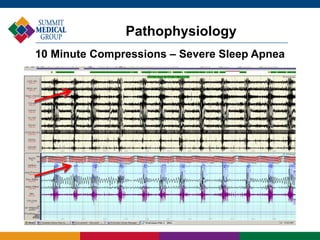 Pathophysiology
10 Minute Compressions – Severe Sleep Apnea
 