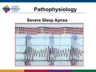 Pathophysiology
Severe Sleep Apnea
 