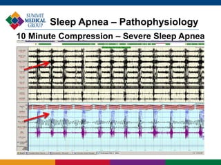 Sleep Apnea – Pathophysiology
10 Minute Compression – Severe Sleep Apnea
 