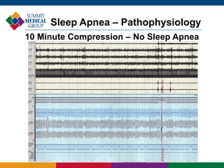 Sleep Apnea – Pathophysiology
10 Minute Compression – No Sleep Apnea
 