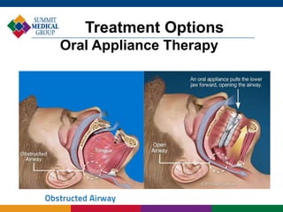 Treatment Options
Oral Appliance Therapy
 