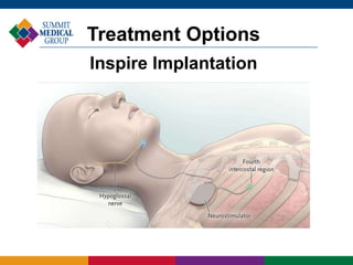 Treatment Options
Inspire Implantation
 
