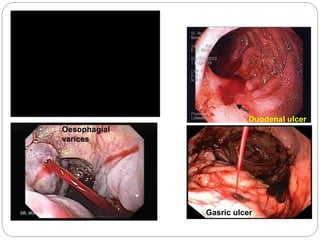 Duodenal ulcer
Gasric ulcer
Oesophagial
varices
 