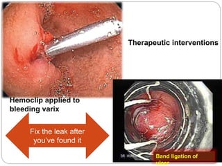 Hemoclip applied to
bleeding varix
Band ligation of
ulcer
Therapeutic interventions
Fix the leak after
you’ve found it
 