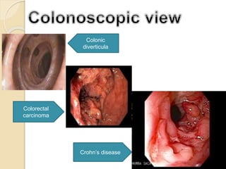 Crohn’s disease
Colorectal
carcinoma
Colonic
diverticula
 
