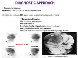 Repeated endoscopy:
Repeat esophagoduodenoscopy and colonoscopy
Identifies the lesion in 35% cases (most cases distal to ligament of Treitz)
Conventional imaging:
RBC scanning, angiography
Provocative tests
Small bowel enteroclysis (largely abandoned now)
Computed tomographic enterography
Meckel’s diverticulum scanning (especially in young patients)
Meckel’s scan
Small bowel enteroclysis
 