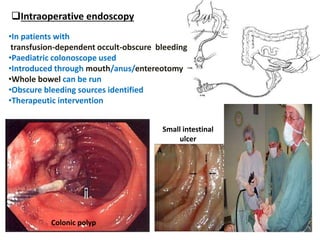Intraoperative endoscopy
•In patients with
transfusion-dependent occult-obscure bleeding
•Paediatric colonoscope used
•Introduced through mouth/anus/entereotomy
•Whole bowel can be run
•Obscure bleeding sources identified
•Therapeutic intervention
Colonic polyp
Small intestinal
ulcer
 